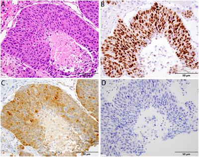 A Case Report of Metastatic Castration-Resistant Prostate Cancer Harboring a PTEN Loss